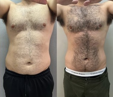 Antes e depois de criomodelagem no abdômen