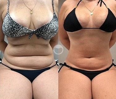 Antes e depois de criomodelagem no abdômen e flancos