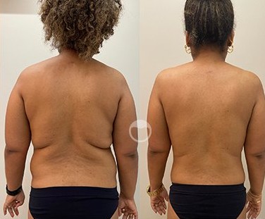 Antes e depois de criomodelagem nas costas