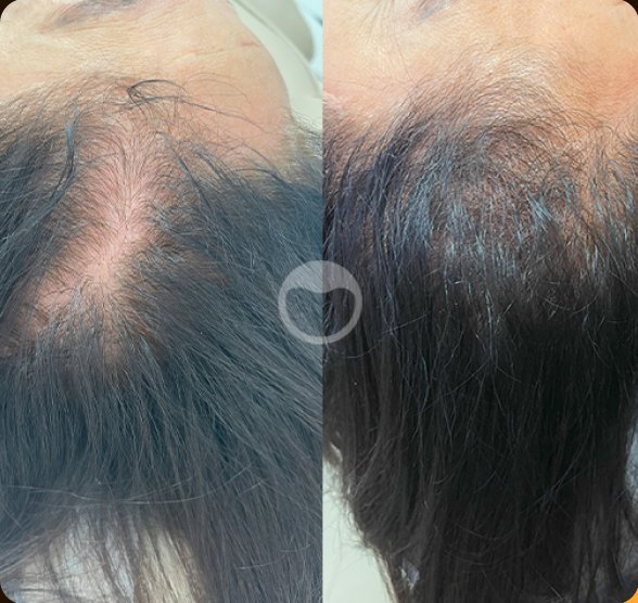 Antes e depois da terapia capilar