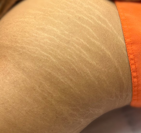 Pele tratada com estética corporal